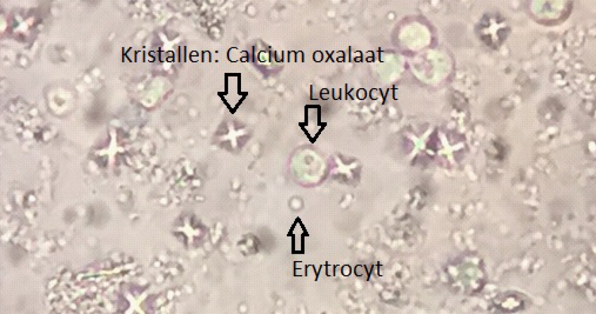 Urine sediment